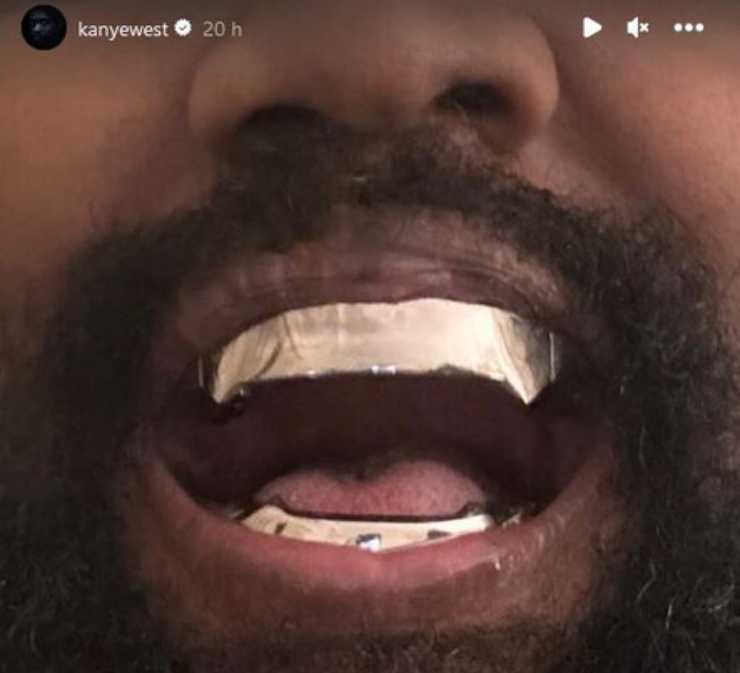 Kanye West si è fatto rimuovere i denti, al loro posto una protesi in titanio da 850mila dollari