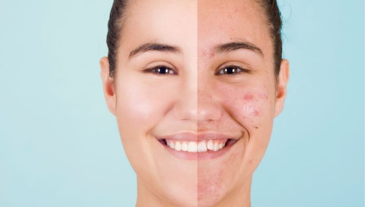 la nuova scoperta sulla cura dell'acne