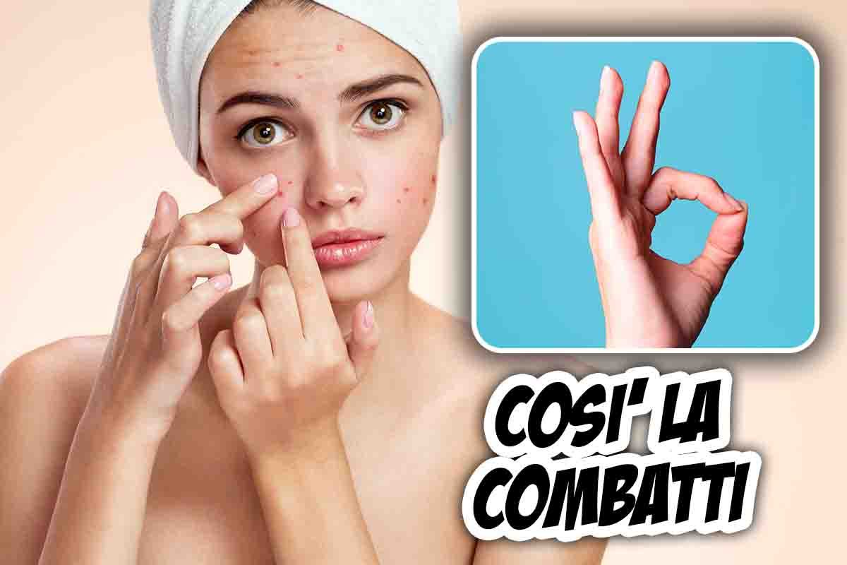 una nuova cura per l'acne
